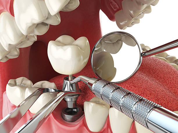 Best Emergency Tooth Extraction in Mission, OR